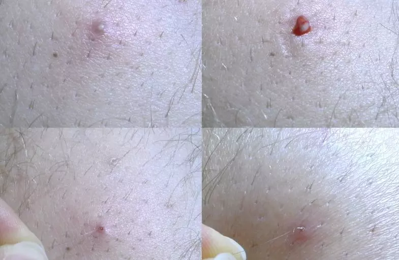 ingrown hair 1