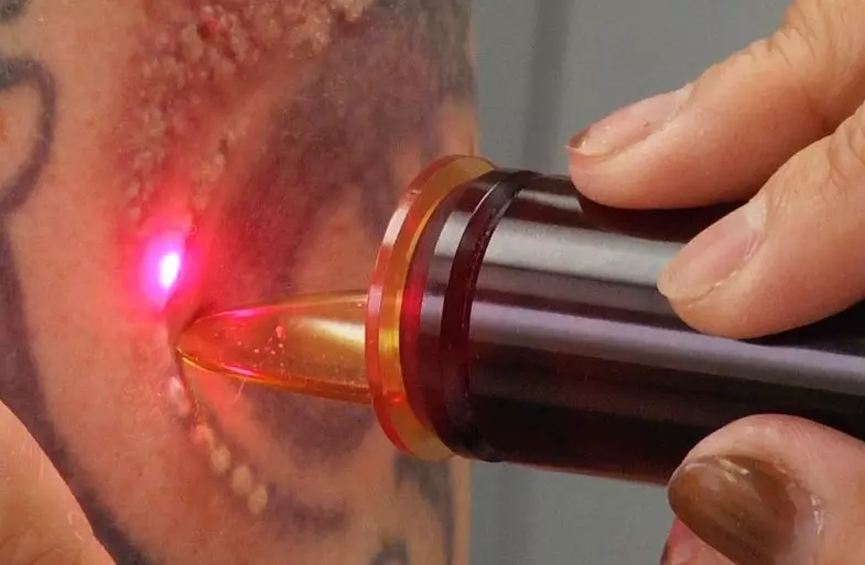 remove a tattoo with a laser